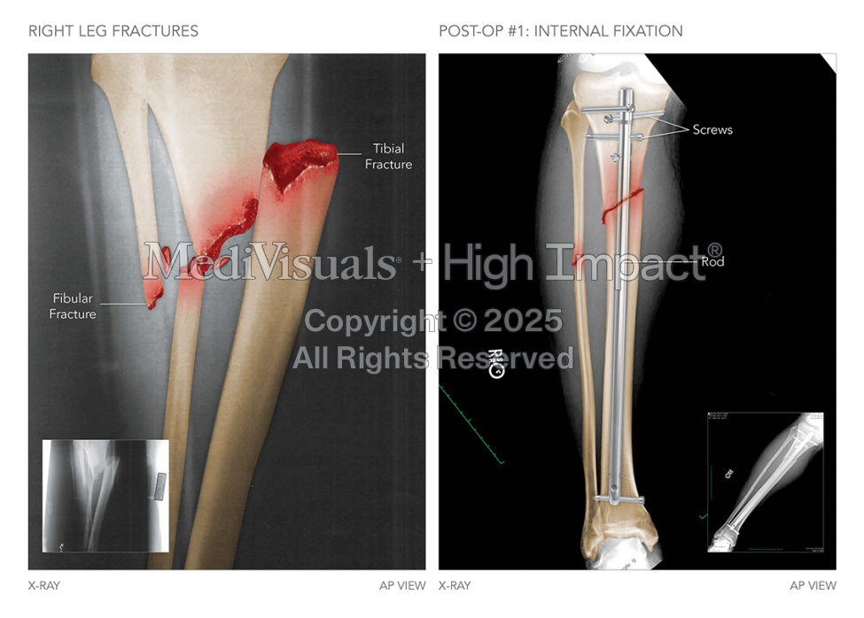 Right Leg Fractures