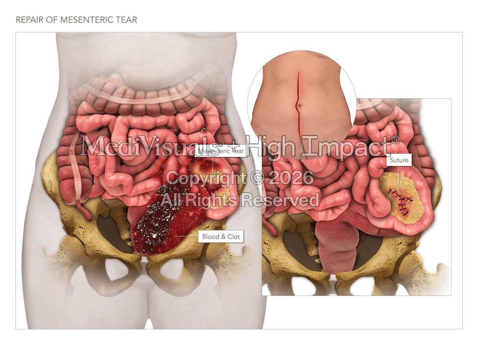 Injuries and Repair to the Abdomen & Leg