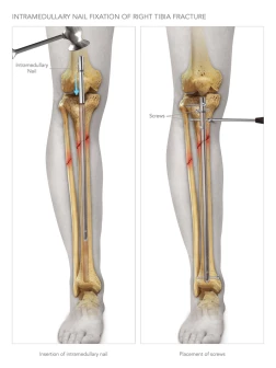 Intramedullary Nail Fixation Of Right Tibia Fracture