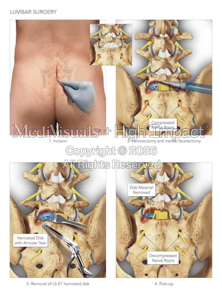Lumbar Surgery