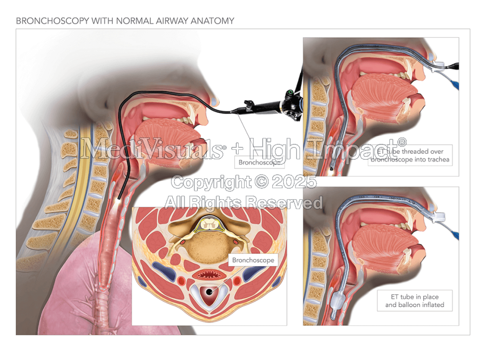 Bronchoscopy With Normal Airway Anatomy