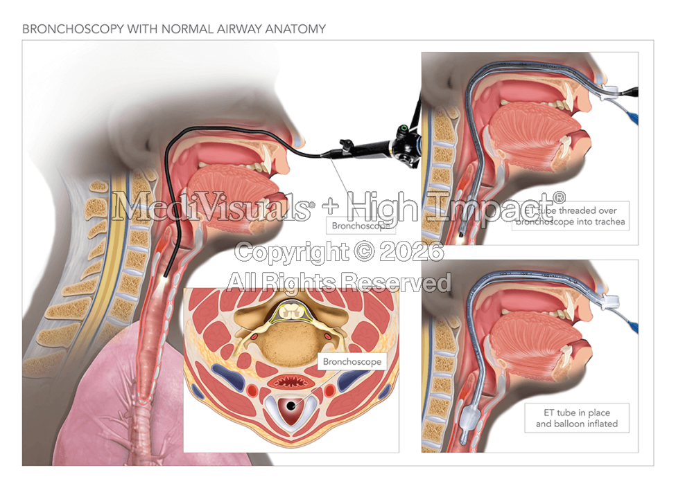 Bronchoscopy With Normal Airway Anatomy