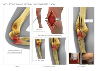 ORIF of Left Elbow