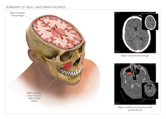 Summary of Skull And Brain Injuries