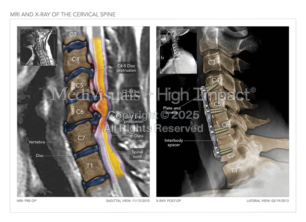 MRI and X-Ray of the Cervical Spine