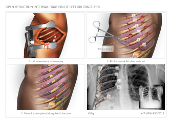 ORIF of Left Rib Fracture