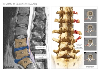 Summary of Lumbar Spine Injuries