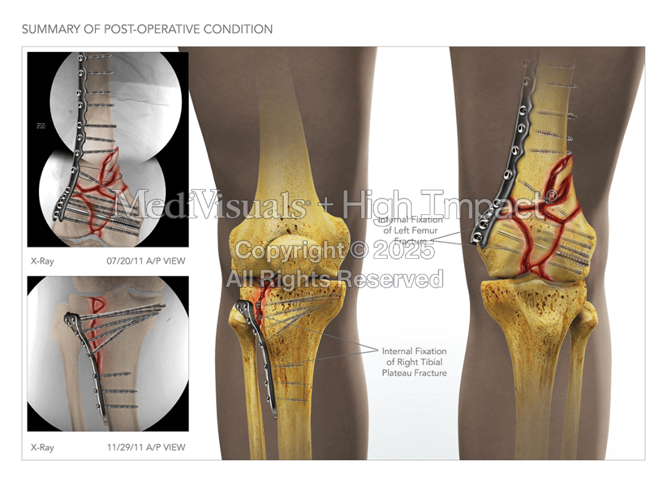 Summary of Post-Operative Condition