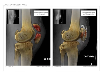 X-Rays of The Left Knee