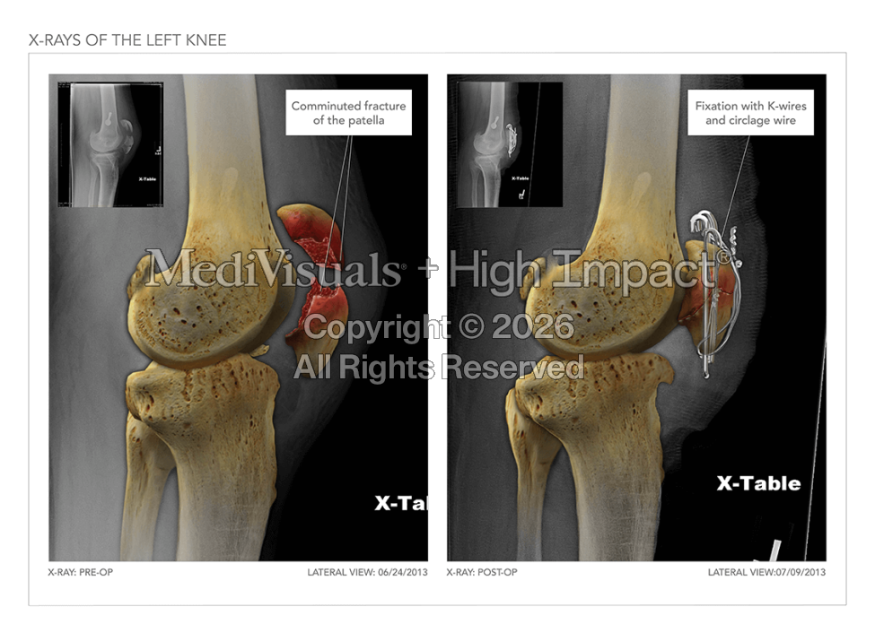 X-Rays of The Left Knee