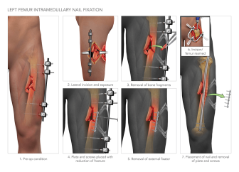 Left Femur Intramedullary Nail Fixation