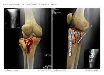Pre & Post Op Right Knee