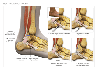 Right Ankle/Foot Surgery