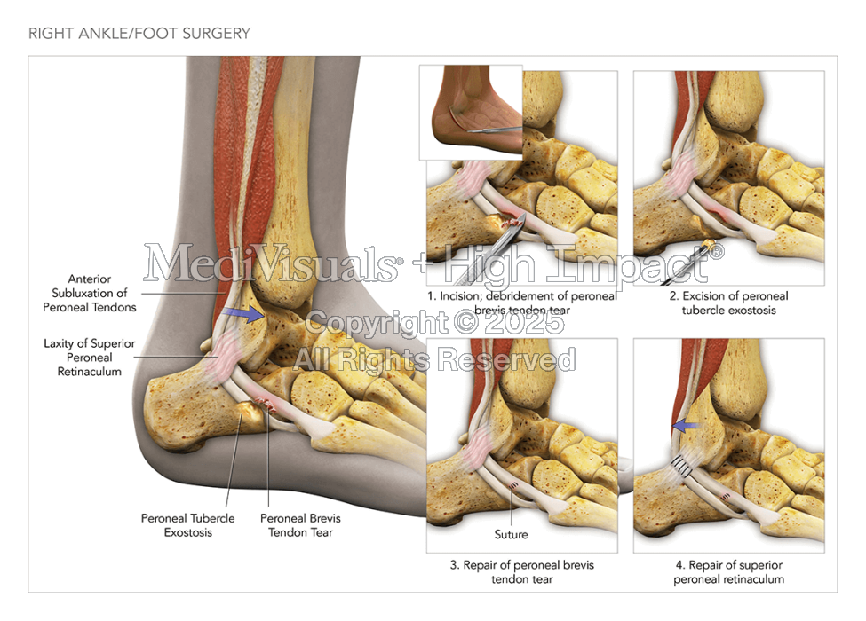 Right Ankle/Foot Surgery