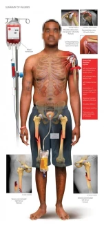 Summary of Injuries