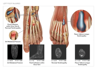 Left Foot Injuries