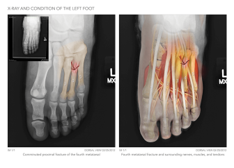 Left Foot X-Ray