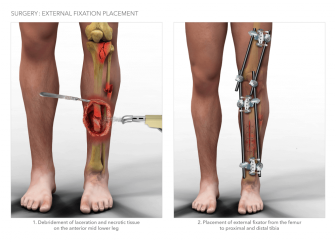Lower Leg External Fixation