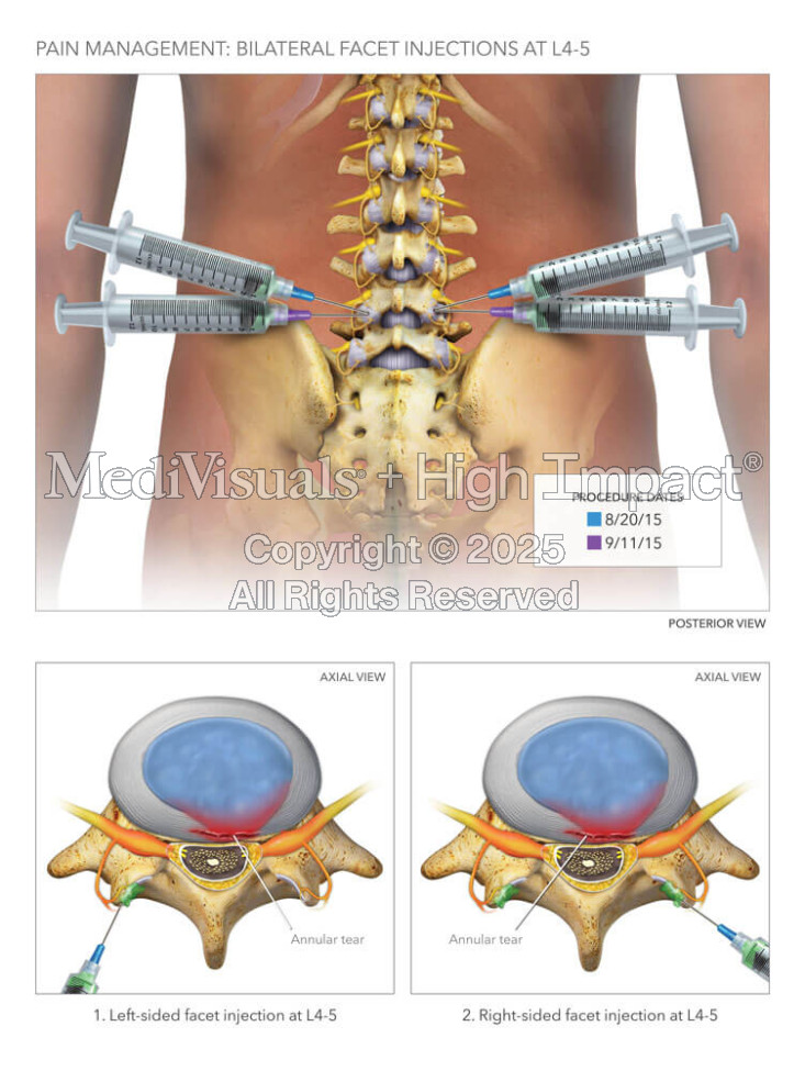 Lumbar Facet Joint Injections