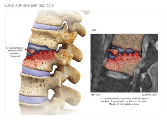 Lumbar Spine Injury