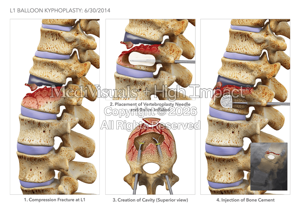 What Is Medical Legal Illustration and Why It Matters in Litigation