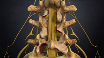 Lumbar Decompression and Fusion