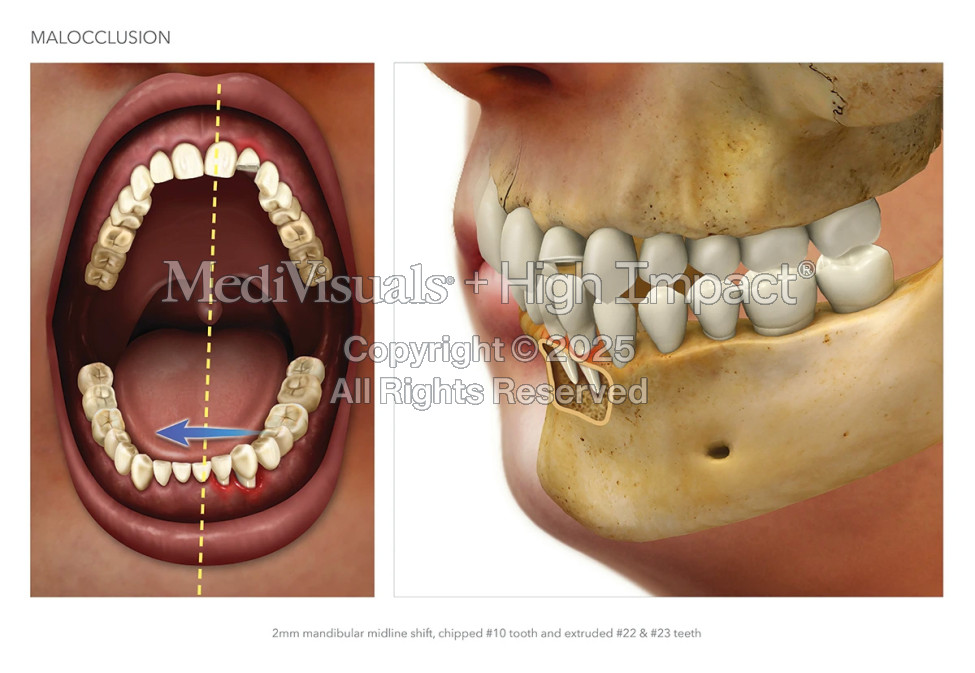 $1M Settlement: Illustrating Fractured Jaw After Cyclist Hit by Truck