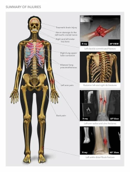 Summary of Injuries