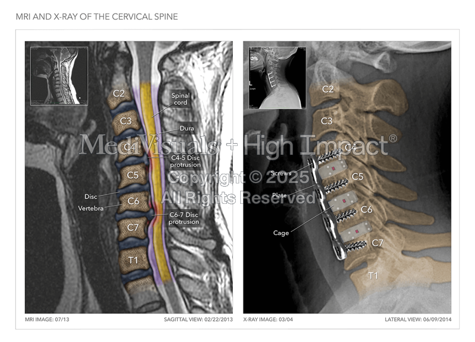 MRI & X-Ray of Cervical Spine