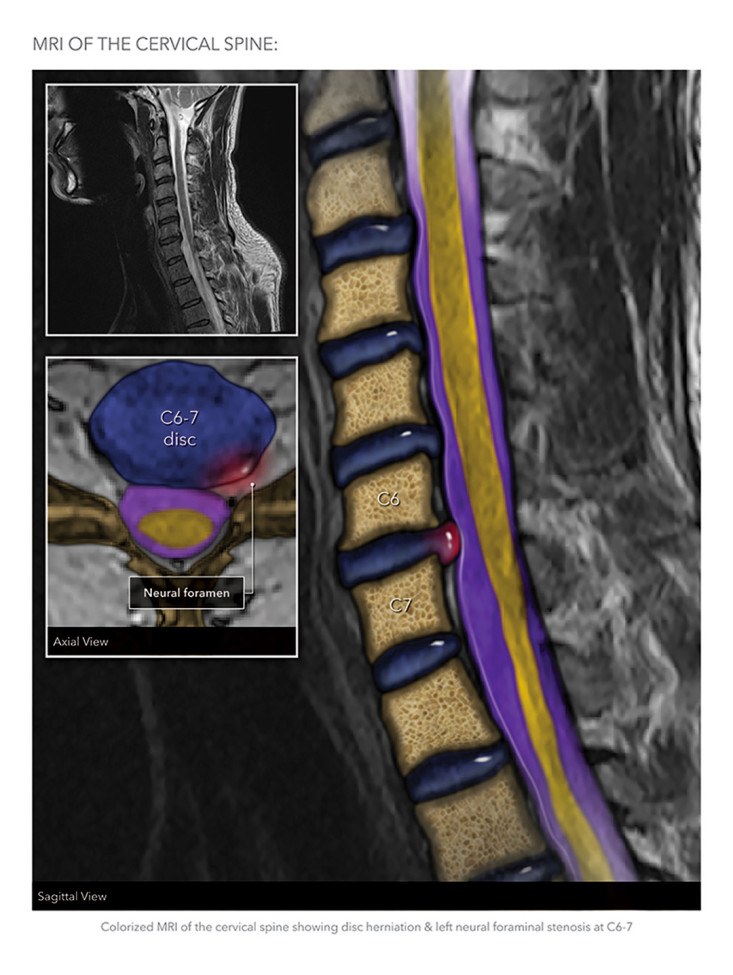 $395k Verdict On $9.9k Offer: Colorized MRIs Prove Liability