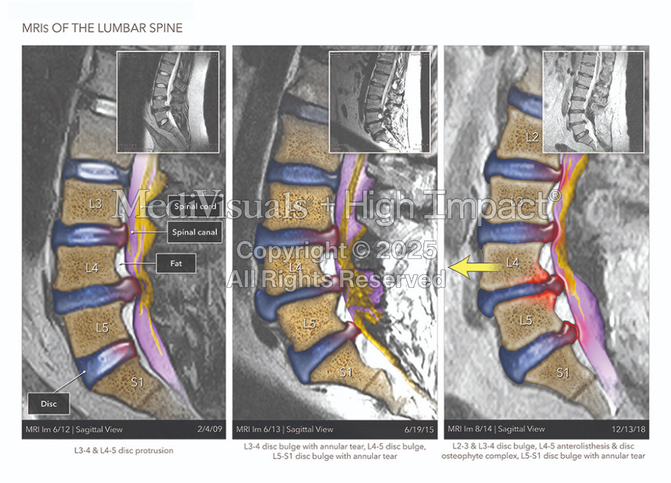 $1.55M Settlement: Colorized MRIs and Medical Illustrations Effectively Show New Injuries Suffered by Motorcyclist