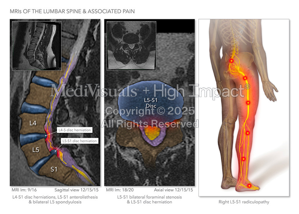 $3.6M Jury Verdict: Illustrating Spine Injuries After Man Hit by Golf Cart