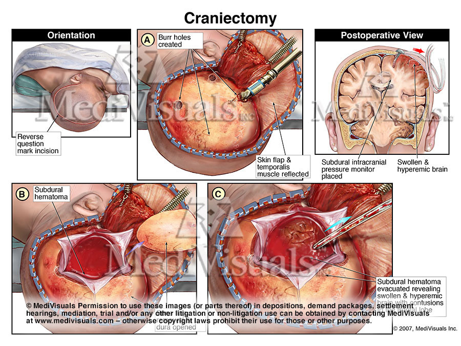 Craniectomy