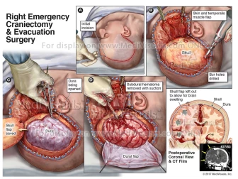 Emergency Craniectomy & Evacuation Surgery