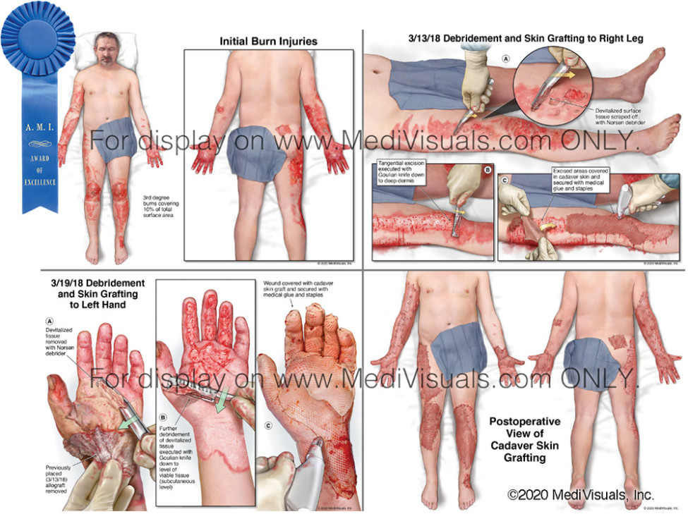 Debridement and Skin Grafting