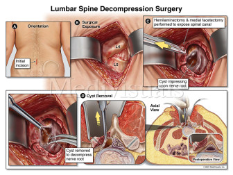 Lumbar Spine Decompression Surgery