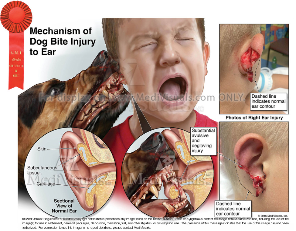 Mechanism of Dog Bite Injury to Ear