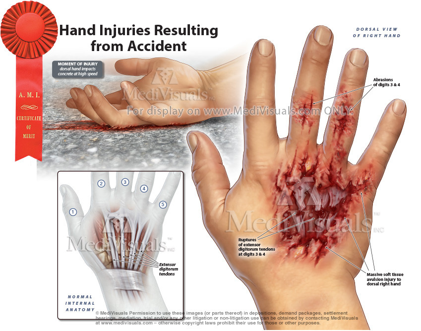 Hand Injuries Resulting from Accident