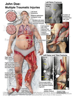 Summary of Multiple Injuries