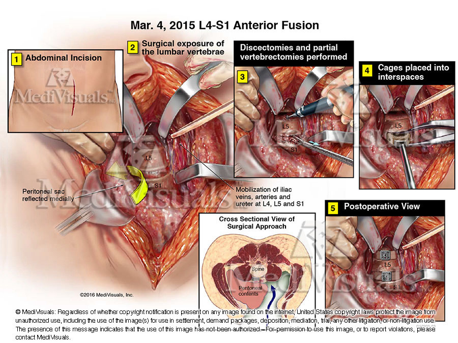 L4–S1 Anterior Fusion