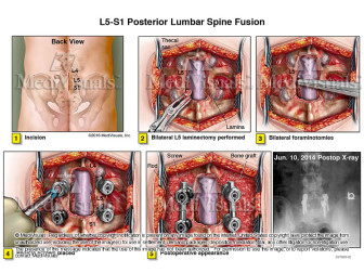 L5-S1 Posterior Lumbar Spine Fusion