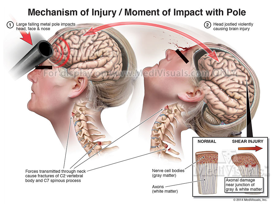 Mechanism of Injury / Moment of Impact with Pole