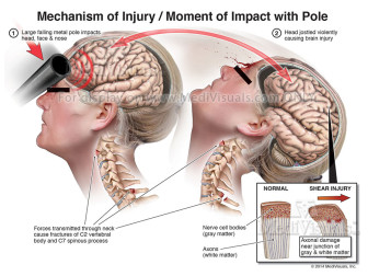 Mechanism of Injury / Moment of Impact with Pole