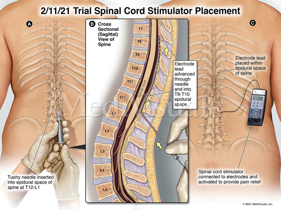 Trial Spinal Cord Stimulator Placement