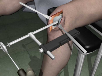 IM Rodding - LEFT Femur