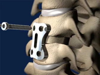 Anterior Discectomy and Cervical Fusion Surgery