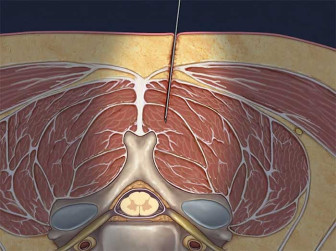 Epidural Injection: Cervical Interlaminar – light skin