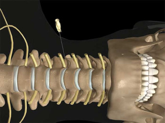 Epidural Injection: Cervical Transforaminal – light skin