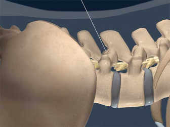 Epidural Injection: Lumbar Interlaminar – light skin
