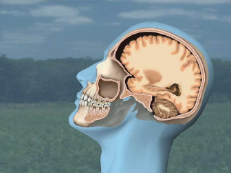 Mild Traumatic Brain Injury - Rear Impact